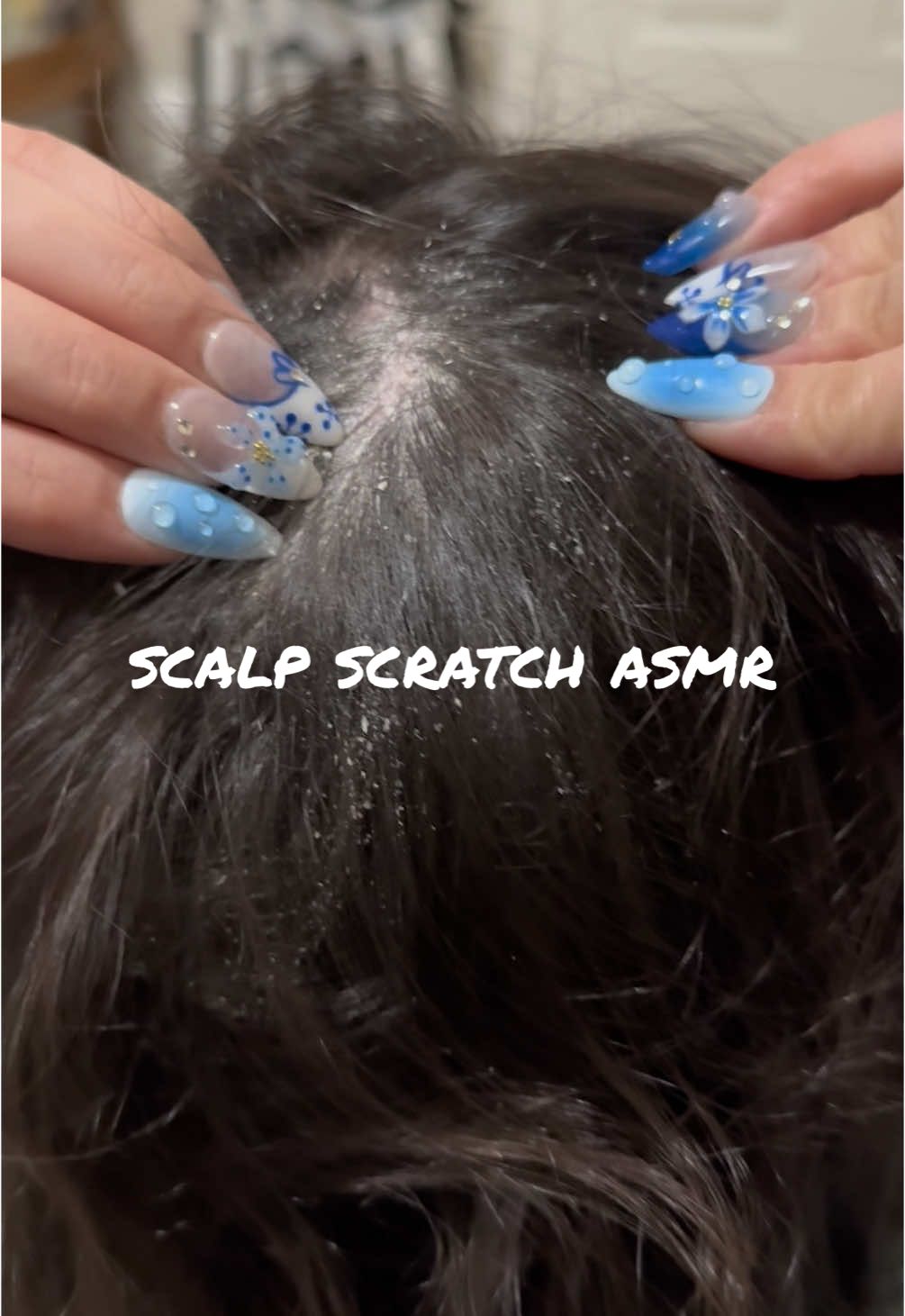 Replying to @Corey you ask and you shall receive 😏 enjoy some scalp itching asmr !! MERRY CHRISTMAS! ❤️ #chronicillness #autoimmunedisease #psoriasis #scalppsoriasis #asmr #scratch #itchyscalp #flakes 