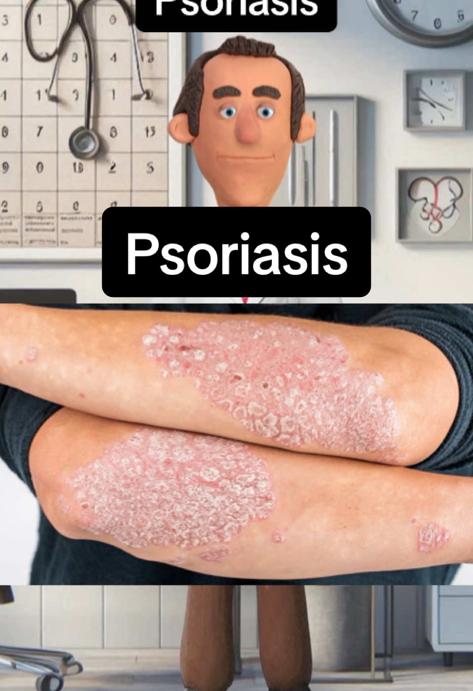 Psoriasis #psoriasis #vulgarisation #medecine #dermato #ifsi #etudianteinfirmière #etudiantmedecine 