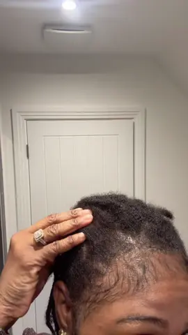 Replying to @IgboQueen 🇬🇧 🇳🇬 #hairtransplant 