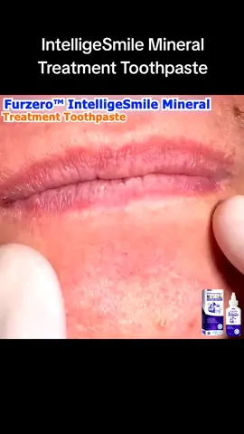 Are you willing to continue to bear high dental bills? #OralCare #HealthyTeeth #WhiteTeeth #SmileGoals #TeethWhitening #BrightSmile #FreshBreath #DentalRoutine #NaturalOralCare #EcoFriendlyProducts #ZeroWasteLifestyle #TikTokMadeMeBuyIt #GlowUpJourney #SelfCareRoutine #ProductReview #ConfidenceBoost