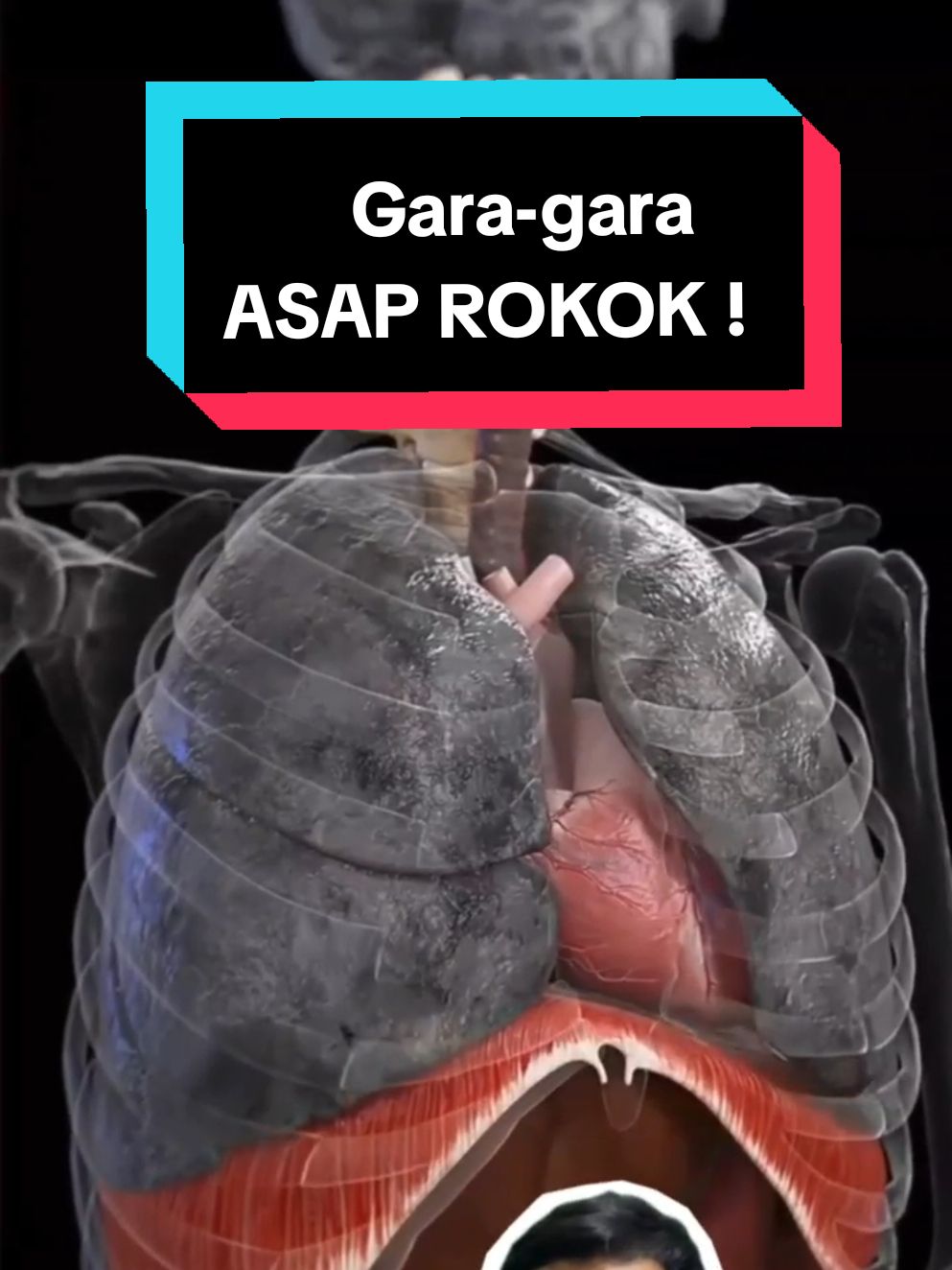 🚬 Zat Toksin dalam Rokok dan Efeknya pada Kesehatan 🚬 Rokok mengandung lebih dari 7.000 zat kimia, banyak di antaranya berbahaya bagi kesehatan. Berikut adalah beberapa zat toksin utama dan efeknya: Nikotin: Efek: Menyebabkan ketergantungan, meningkatkan detak jantung, dan tekanan darah. Tar: Efek: Mengendap di paru-paru, menyebabkan kerusakan jaringan, dan meningkatkan risiko kanker paru-paru. Karbon Monoksida: Efek: Mengurangi kemampuan darah untuk mengangkut oksigen, meningkatkan risiko penyakit jantung. Formaldehid: Efek: Zat karsinogenik yang dapat menyebabkan iritasi pada saluran pernapasan dan meningkatkan risiko kanker. Amonia: Efek: Dapat merusak jaringan paru-paru dan meningkatkan risiko infeksi pernapasan. Benzena: Efek: Dikenal sebagai karsinogen, dapat menyebabkan leukemia dan gangguan darah. Arsenik: Efek: Toksik bagi sistem saraf dan dapat menyebabkan kanker. Kadmium: Efek: Merusak ginjal dan dapat menyebabkan osteoporosis. Paparan jangka panjang terhadap zat-zat ini dapat menyebabkan berbagai penyakit serius, termasuk kanker, penyakit jantung, dan gangguan pernapasan. Mari kita tingkatkan kesadaran akan bahaya merokok dan jaga kesehatan kita! 💔🌱 #StopMerokok #Kesehatan #ZatToksin #HidupSehat #rokok #asaprokok #kankerparu 