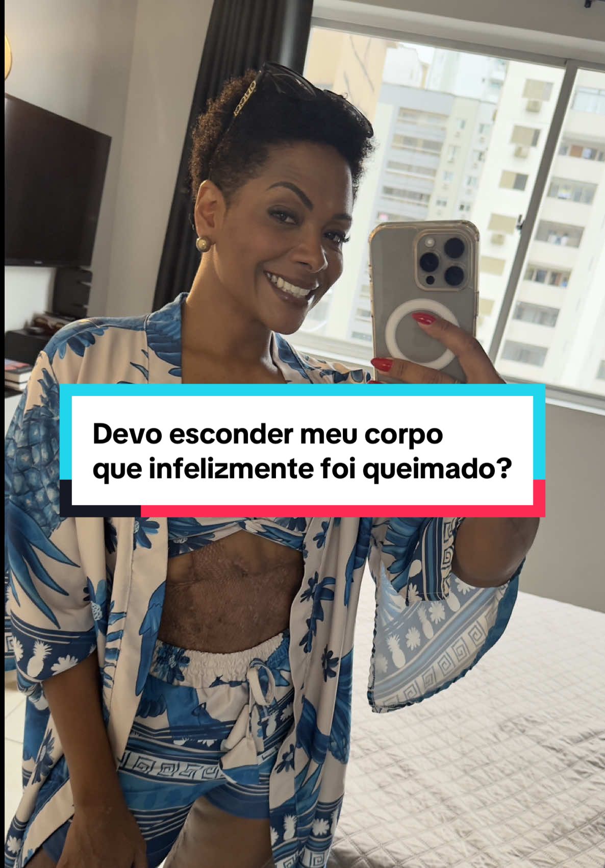 Não tenho vergonha de mostrar meu corpo! Desejo que muitas mulheres se inspirem e se amem, do jeitinho que são. Lamento profundamente que essa infelicidade tenha acontecido comigo. Mas sou uma sobrevivente, sou forte, sou corajosa e sou determinada a viver o melhor dessa vida, pois estou viva .