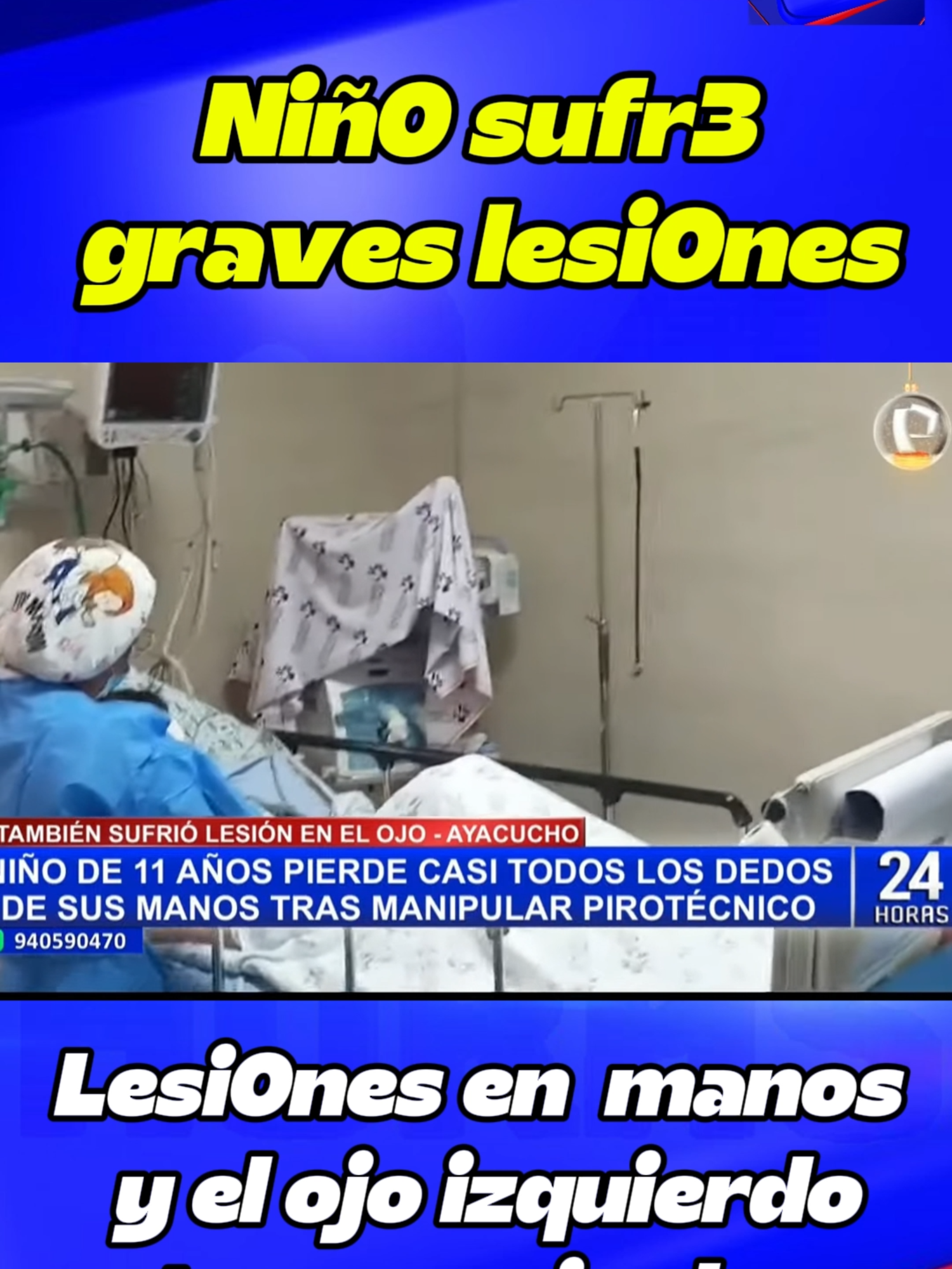 24horas - Terrible lesi0nes   sufr3 niñ0 tras manipular pirotecnico #fyp #foruyou #panamericanatv #foryour #viral_video #perú #todoelmundo #latinos #peruanos #peruanosenelmundo #noticias #personal #24horas #ayacucho_peru🇵🇪🇵🇪 #lima #paratiiiiiiiiiiiiiiiiiiiiiiiiiiiiiii #paratí #pnp #policianacionaldelperú