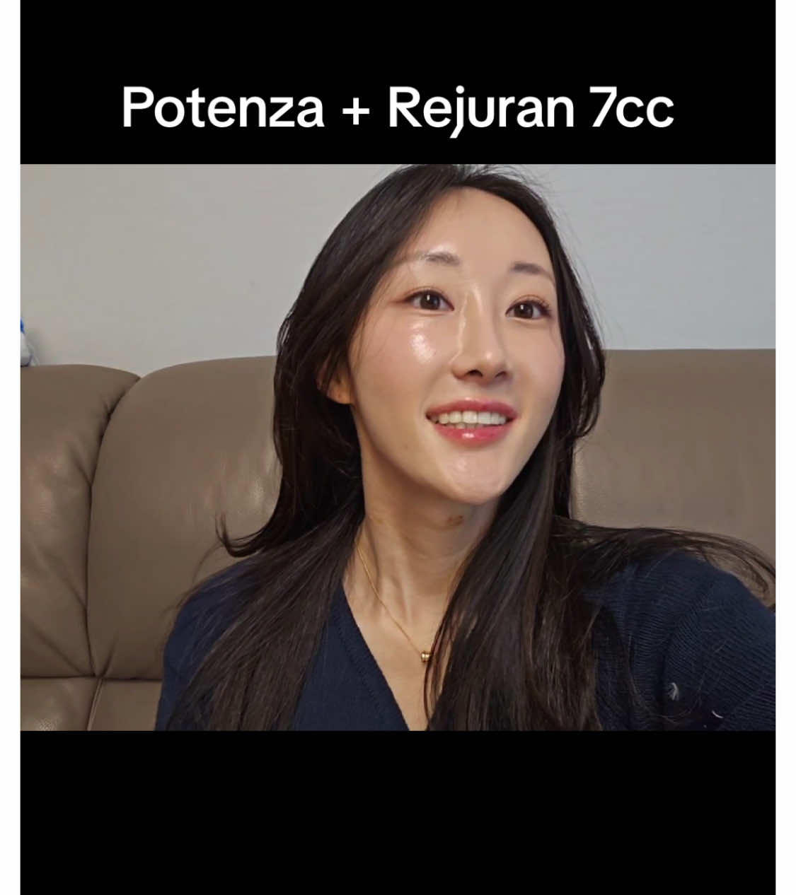 Potenza + Rejuran 7cc 포텐자+리쥬란 7cc 셀프로 시술하는 원장님 피부 (우리 원장님이 욕심쟁이라 그래요... 4cc만 해도 충분합니다^^;) 요철, 잔주름 없는 피부를 만들 땐 포텐자가 필수! 피지선을 줄여주기 때문에 여드름성 피부를 치료하는 데도 좋다는 사실! 포텐자는 시술하고 1~2주는 각질이 많아지기 때문에 원래보다 트러블이 올라올 수 있어요!! 2주 지나면 보들보들 매끈해집니다~ 현재 진행중인 새해맞이특가 1월 15일까지인데 ↓비용 엄청 저렴하게 이벤트중입니다!! 리쥬란2cc 14,9000원 리쥬란 아이 1cc 89,000원 당신의 아름다움이 다시 태어나도록, 오르타의원 02-6251-9755 #오르타의원 #신논현역 피부과 #강남역 피부과 #포텐자 #리쥬란 #여드름피부  -------------------------------- Potenza + Rejuran 7cc 自我施术的院长皮肤（我们院长是个爱贪心的人... 4cc就足够了^^;） 制作平滑无瑕疵的皮肤时，Potenza是必不可少的！ 它能减少皮脂腺，对治疗痤疮皮肤也很有效！ 施术后1到2周，由于角质增多，可能会比原来更多地出现痘痘。两周后，皮肤会变得更加光滑柔软~ 目前正在进行的新年特惠活动，直到1月15日↓费用非常优惠，活动中！！ Rejuran 2cc 14,9000元 Rejuran Eye 1cc 89,000元 让您的美丽重生，Oorta皮肤科 02-6251-9755 #Orta皮肤科 #新论峴站皮肤科 #江南站皮肤科 #Potenza #Rejuran #痤疮皮肤  