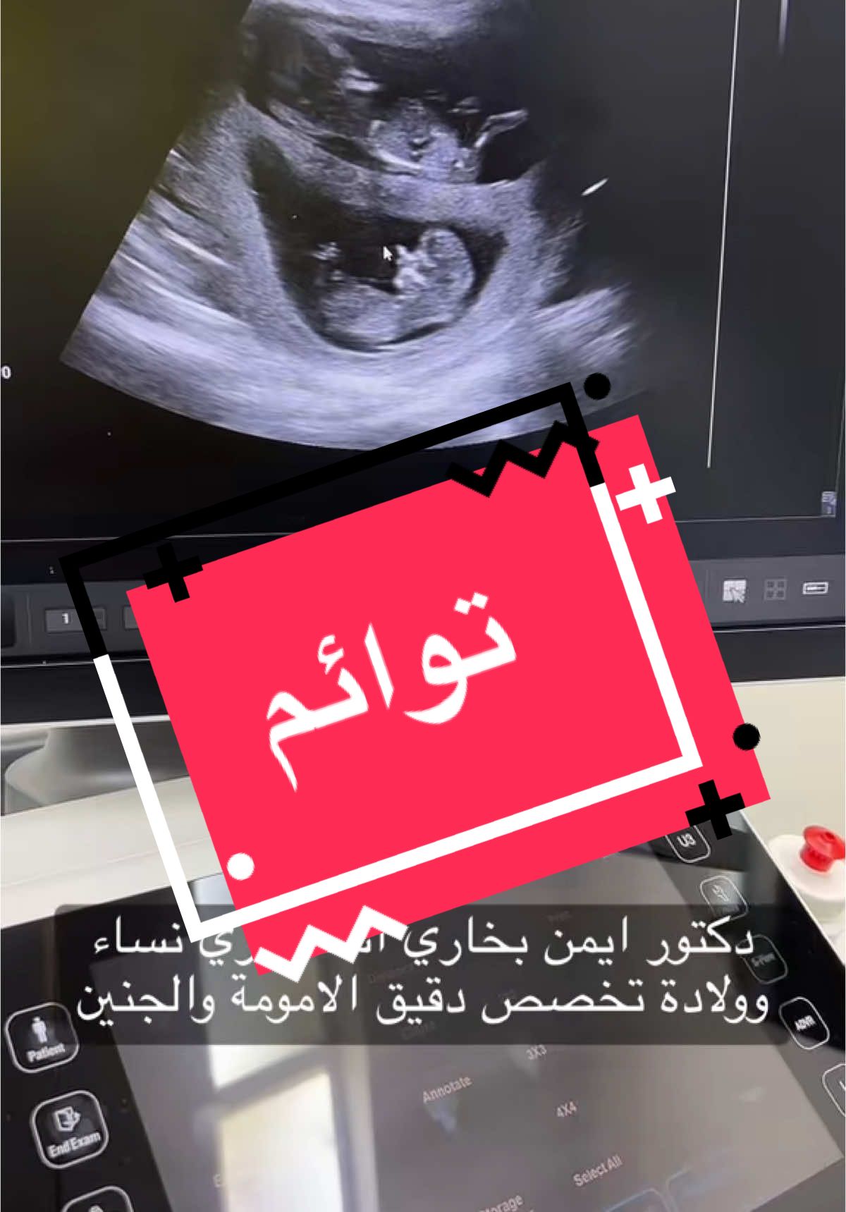 متابعة حمل التوائم تكون مع الاستشاري المتخصص في الأمومة والجنين  🤰🏻 #انتِ_وطفلك_أولاً💞 #دكتور_ايمن_بخاري #الحمل_والولادة #متابعة_الحمل #الولادة #الولادة_الطبيعية #الولادة_القيصرية #الولادة_بدون_ألم #الحمل_بتوأم 