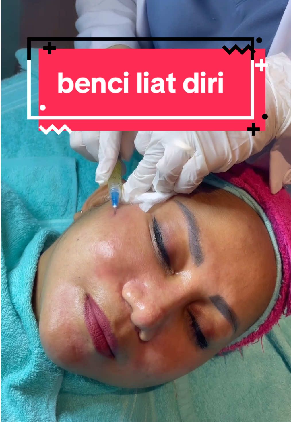 jadi bete sendiri🙂 #fyp #infuswhitening #suntikputih #klinikkecantikanbekasi #delonabekasi #mancunginhidung #klinikkecantikan #delonaaesthetic #tarikbenang #delona #facial #delonasc #ramadhan #benanghidung #botox #aestheticclinic #resolusi2025 #fillerbibir #sexylips #promoakhirtahun #newyearnewlook 