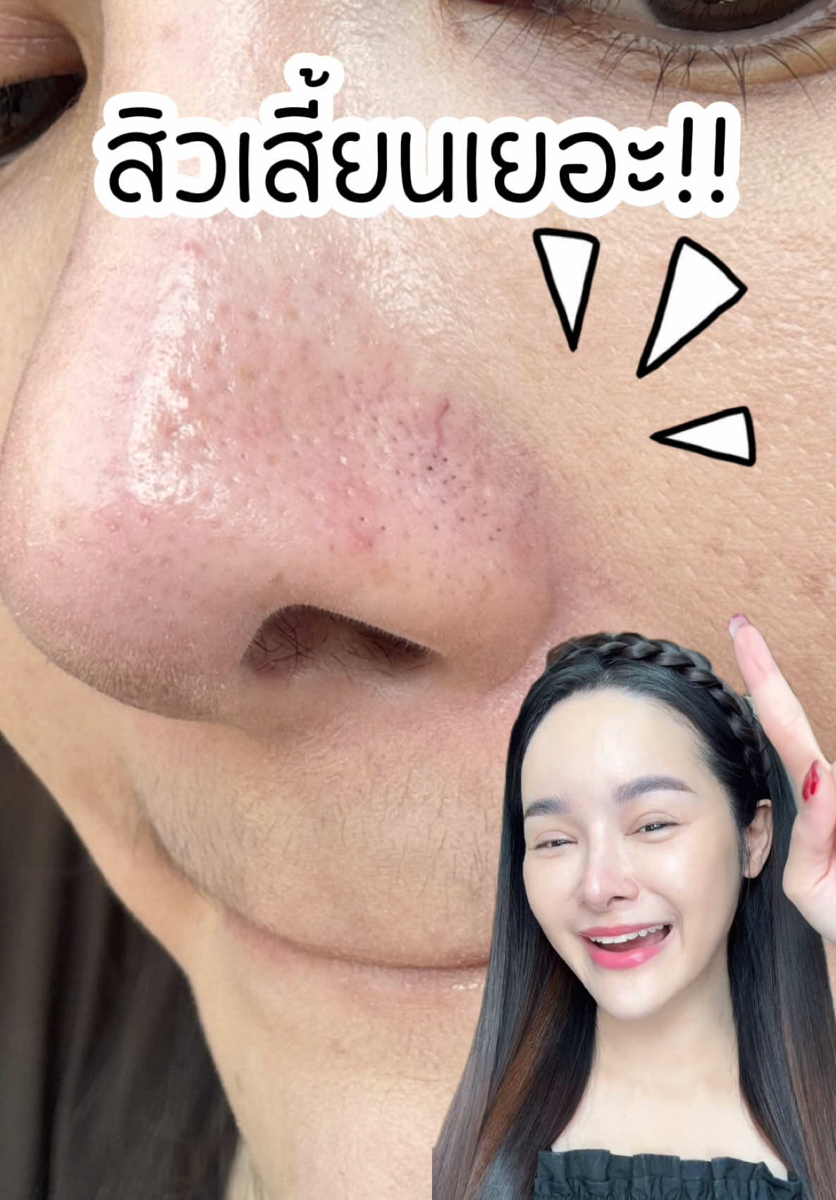 ใครสิวเสี้ยนเยอะแบบเราแล้วพอแต่งหน้าทีไรข้างจมูกเป็นคราบทุกที เราอยากให้ลองนี่เลย!! ไม่ต้องดึงต้องทึ้งให้แสบอีกแล้ว!! #รีวิวบิวตี้ #tiktokป้ายยา #เรื่องผิว #cpercent  #สวยสับไร้เสี้ยน #มาส์กเปปไทด์ดันสิวเสี้ยน #สิวเสี้ยน #mocaxcpercent #mocakol #yingbest