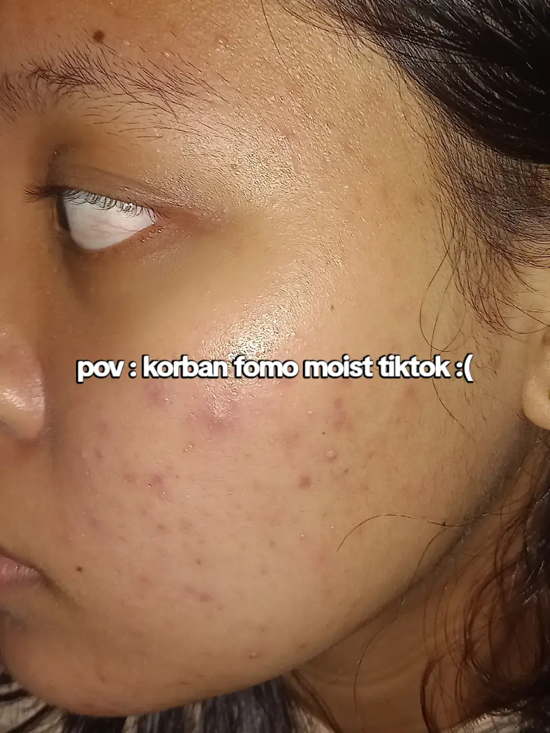 walaupun belum 100% bersih tapi aku secinta itu sama moist viral ini💓 @glowsophyofficial  #acne #fyp #trending 