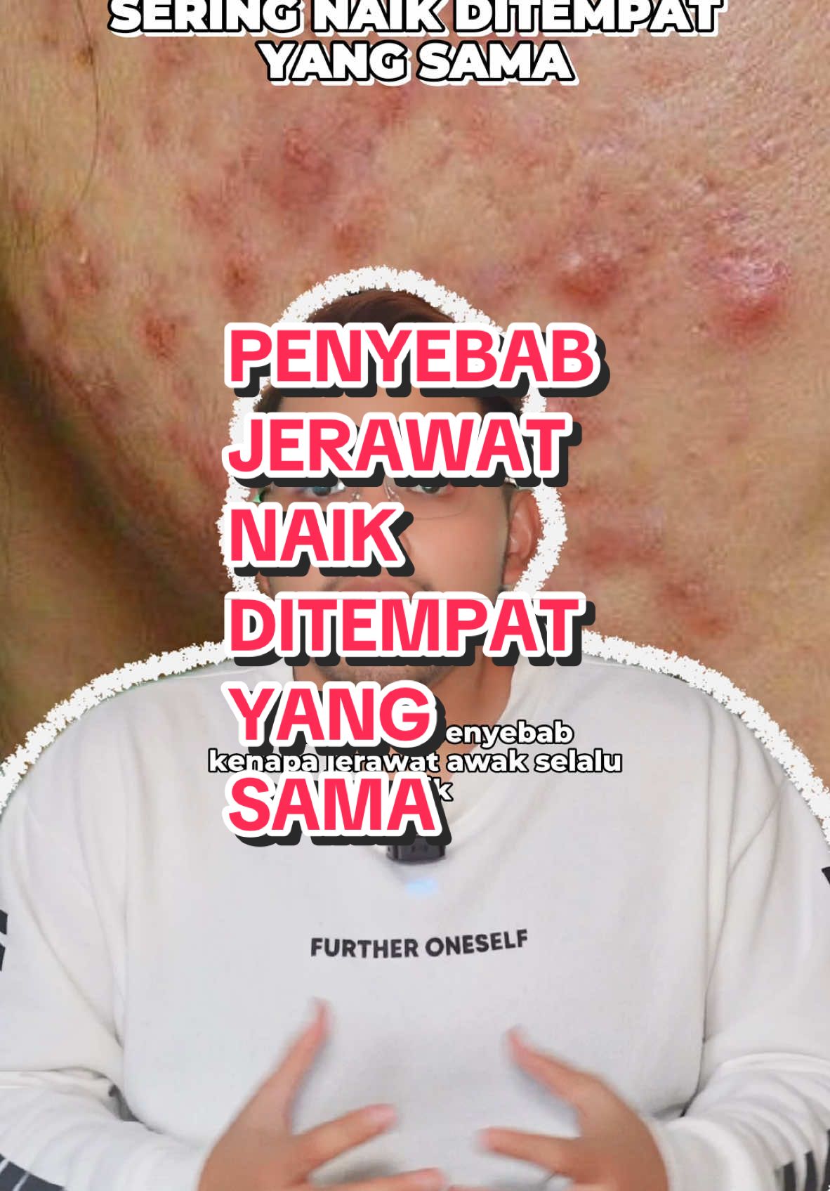 5 penyebab jerawat naik ditempat yang sama. Dengar, faham dan hadamkan. Semoga bermanfaat 😊 #fyp #beautyguru #skintok #BeautyTok #tiktokguru #acneskin #jerawat #acnefighter #healthyskin 