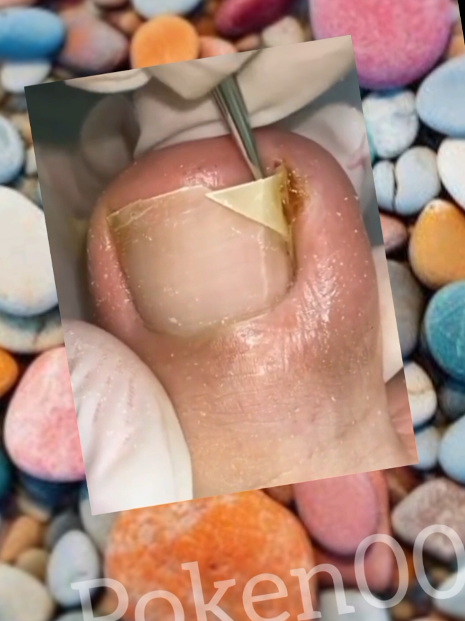 hummm #ingrowntoenail #unhas #limpezadepele #cortes #usa_tiktok #toenailremoval 