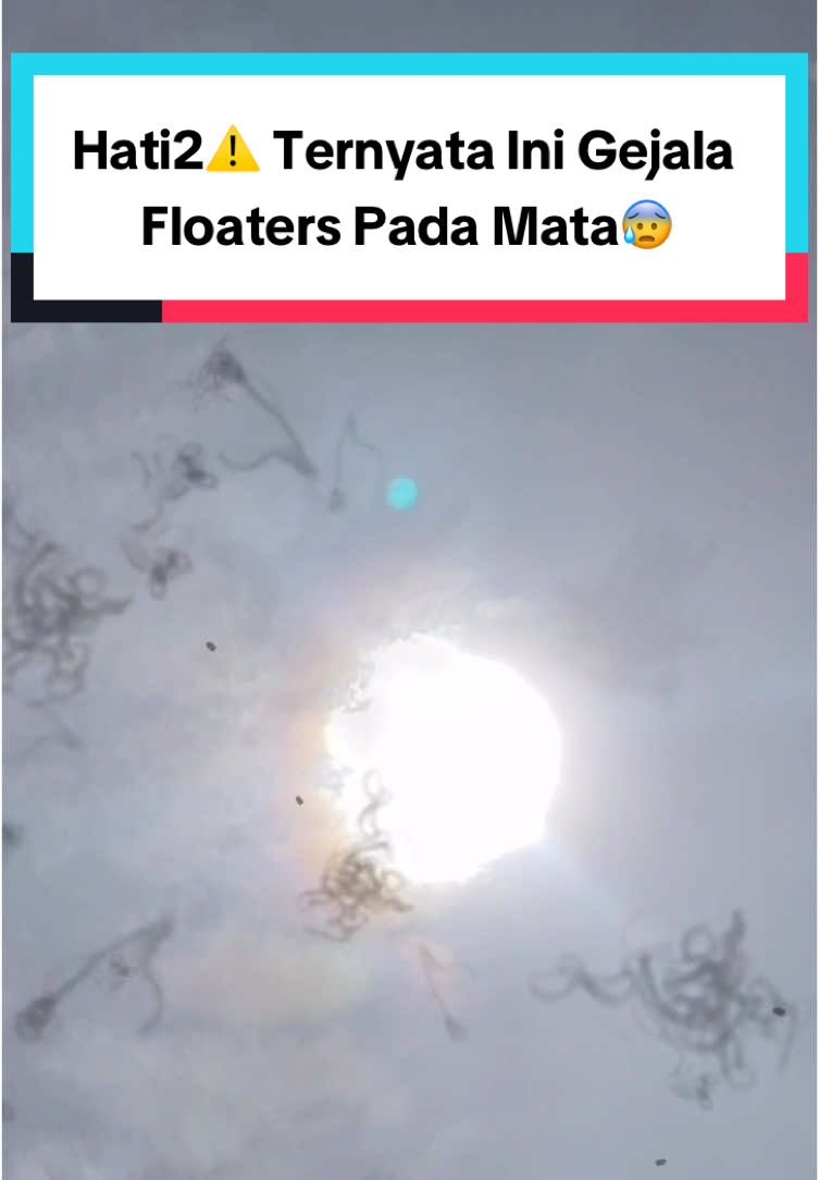 Waduh ternyata kalau penglihatannya kayak gini tandanya gejala Floaters😰 #kacamataminus #mataminus #floaters #floater 