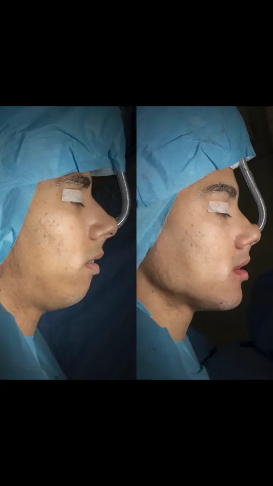 This is how you get a better breathing and a better profile with double jaw surgery and IMPlate  #doublejaw #doublejawsurgery #maxilofacial #ortognatica #doublejawsurgeryrecovery #italia #hardmaxxing #looksmax #looxmaxxing 