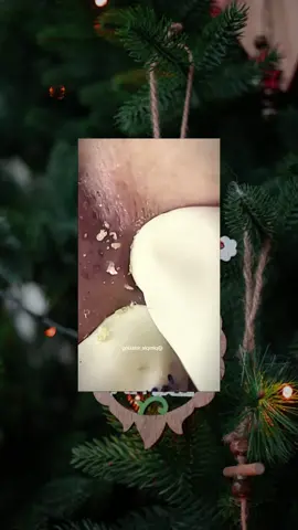 #squeezeyuk #satysfying #pimple #foryou #relax