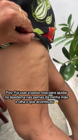 De quebra ganhou uma pele firme e livre das celulites ✨#lipedema #flacidez #pelesaudavel #foliculite #celulite 