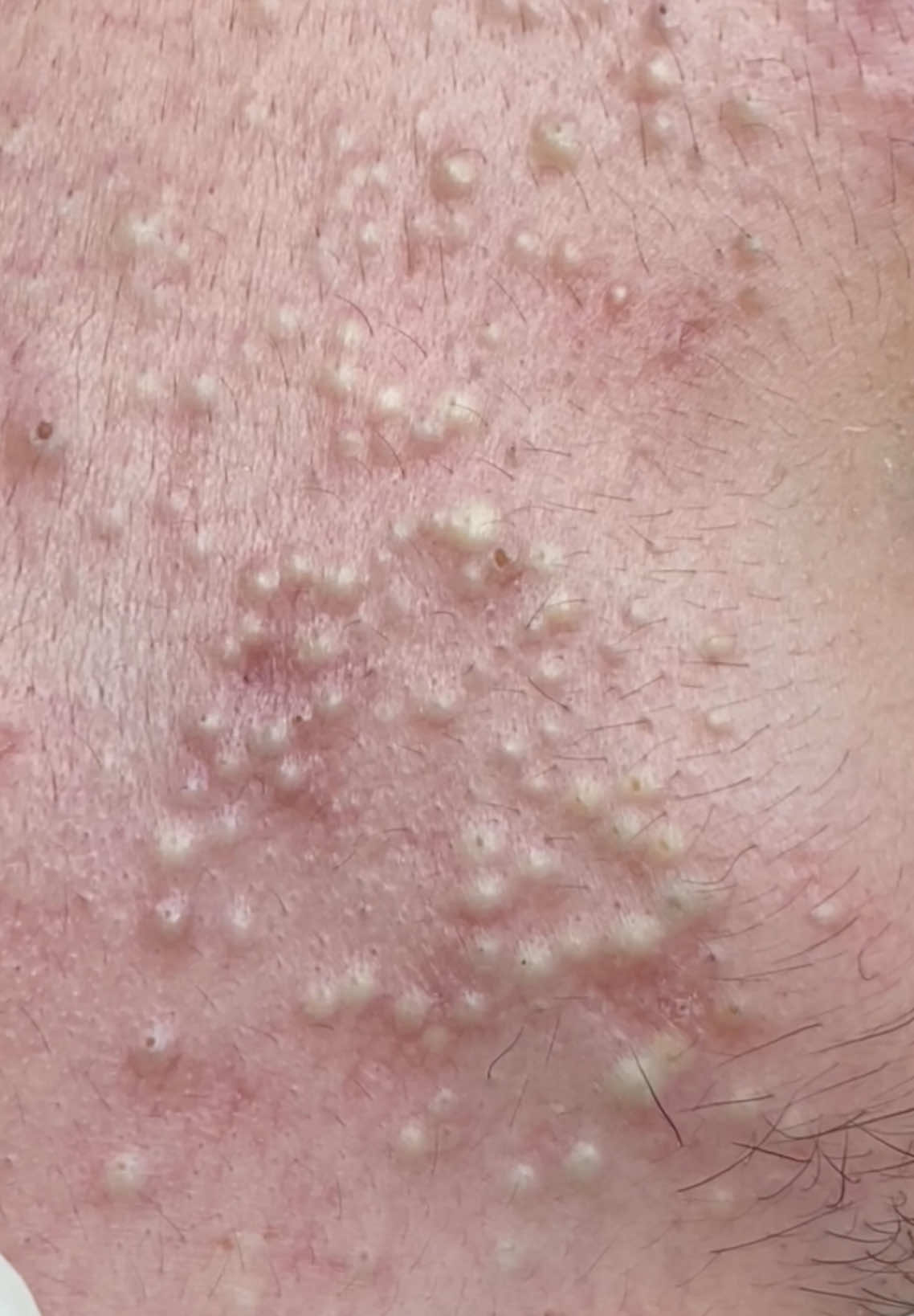 Khó chịu lắm… #sacdepspa #trimungovap #nanmunbangtay #pimple #thuytruong #trimun 