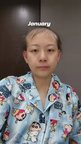 My Hair Growth Journey in 2024 เส้นทางการเดินทางของผมตั้งแต่ต้นปีจนสิ้นปี #มะเร็งตัวร้าย #มะเร็งระยะสุดท้าย #มะเร็งต่อมน้ำเหลือง #มะเร็งต่อมน้ำเหลืองระยะสุดท้าย #มะเร็งต่อมน้ำเหลืองระยะที่4 #มะเร็ง #Hodgkinslymphoma #lymphoma #cancer #แม่ลูกอ่อน #โรคมะเร็ง #ผมยาวเร็ว #เร่งผมยาว #hairgrowth #hairgrowthjourney 