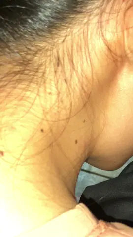Use your fingernails to remove all lice. 😱😬😭#omg #lice #liceremoval #treanding #for 