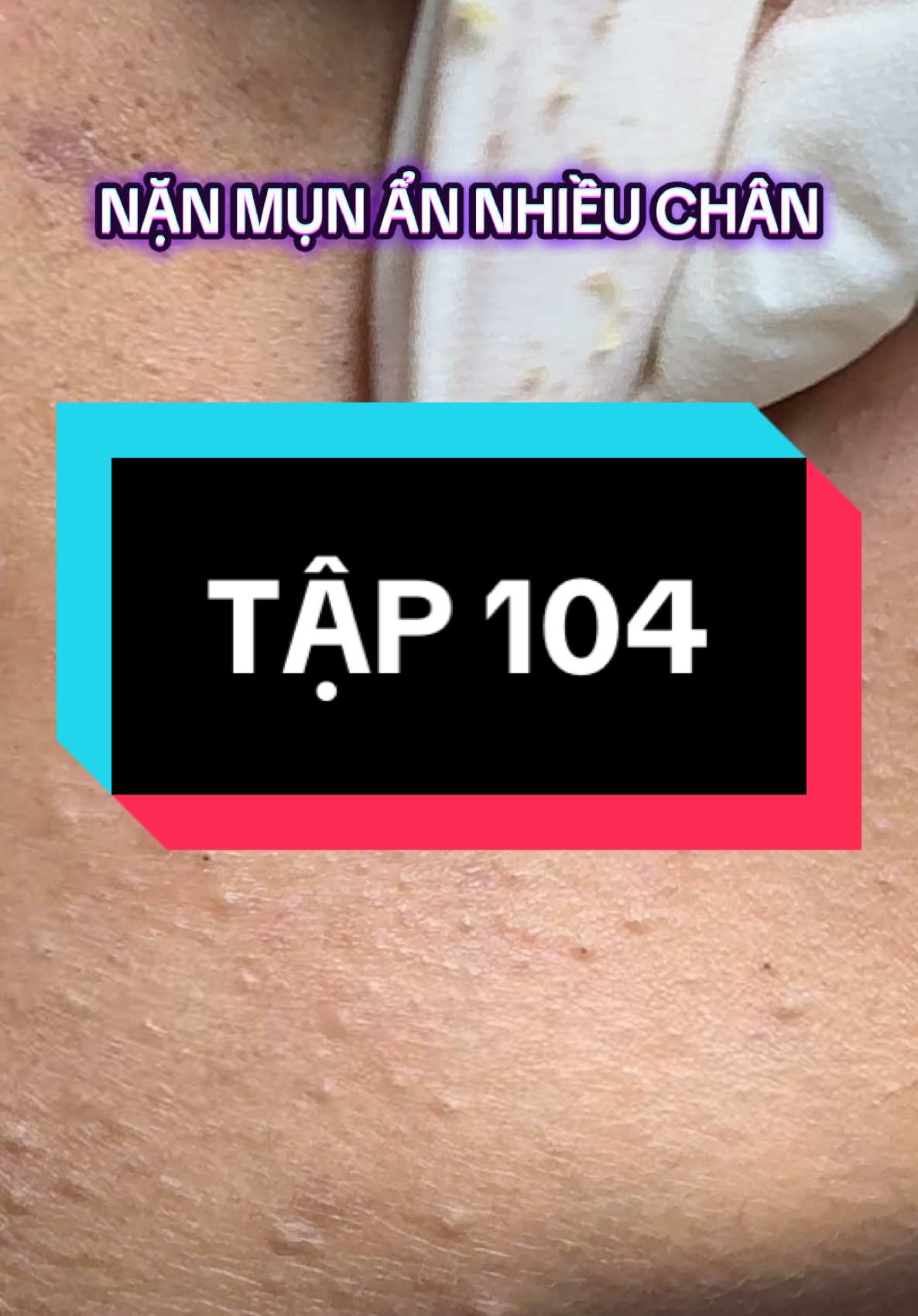 Xem Vula #nặn_mụn #tiktok #chill 