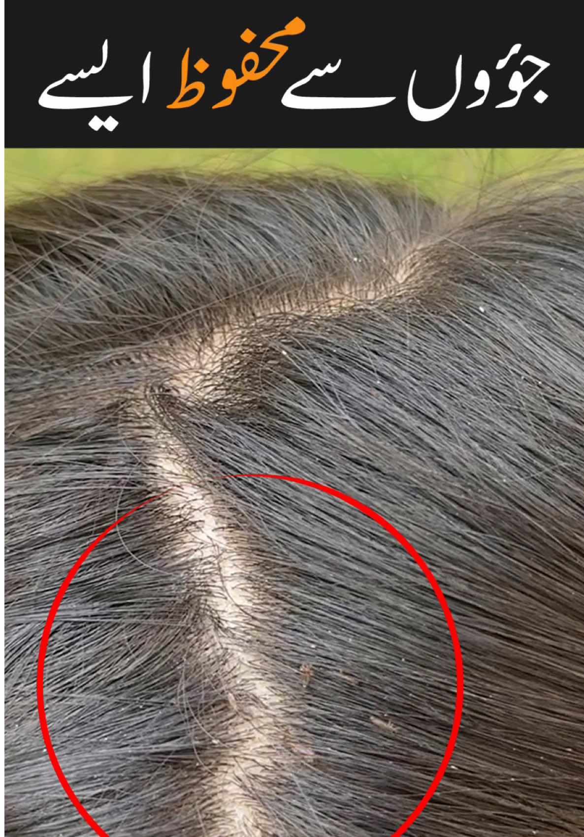 Lice and dandruff removal remedy #longhair #whitehair #tiktok #foryoupage #fyp #goviral #trend2024 #shumailasdiary #shumaila 