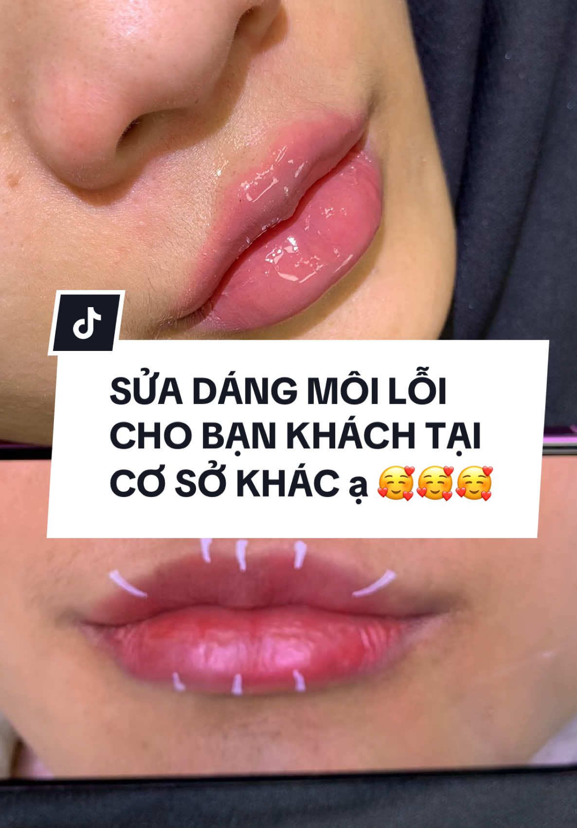 Sửa dáng môi lỗi cho b khách #filler #lamdep #moibaby #tranhueanh #thammy #xuhuong 