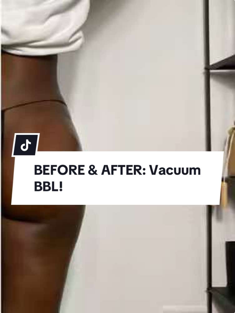 ✨ Vorher vs. Nachher: Vacuum BBL ✨ Nach nur 5 Sessions – sichtbare Ergebnisse ohne invasive Eingriffe! 🍑💪🏽 Vacuum BBL regt die Durchblutung an, formt & strafft. Dein Weg zu einem natürlichen, geformten Look. ➡️ Vorteile: ✅ Hebt & definiert ✅ Fördert die Kollagenbildung ✅ Sichtbare Ergebnisse in kurzer Zeit Hast du Fragen? Schreib mir – lass uns deine Transformation starten! #MaisonDeShape #VacuumBBL #BodyContouring #NonInvasiveTreatment #SkinTightening #ShapeYourBody #BeautyTransformation #GlowUp #BodyGoals #NaturalCurves #ConfidenceBoost #SlimAndSculpt #SelfCareJourney #NonSurgicalTreatment #AestheticCare