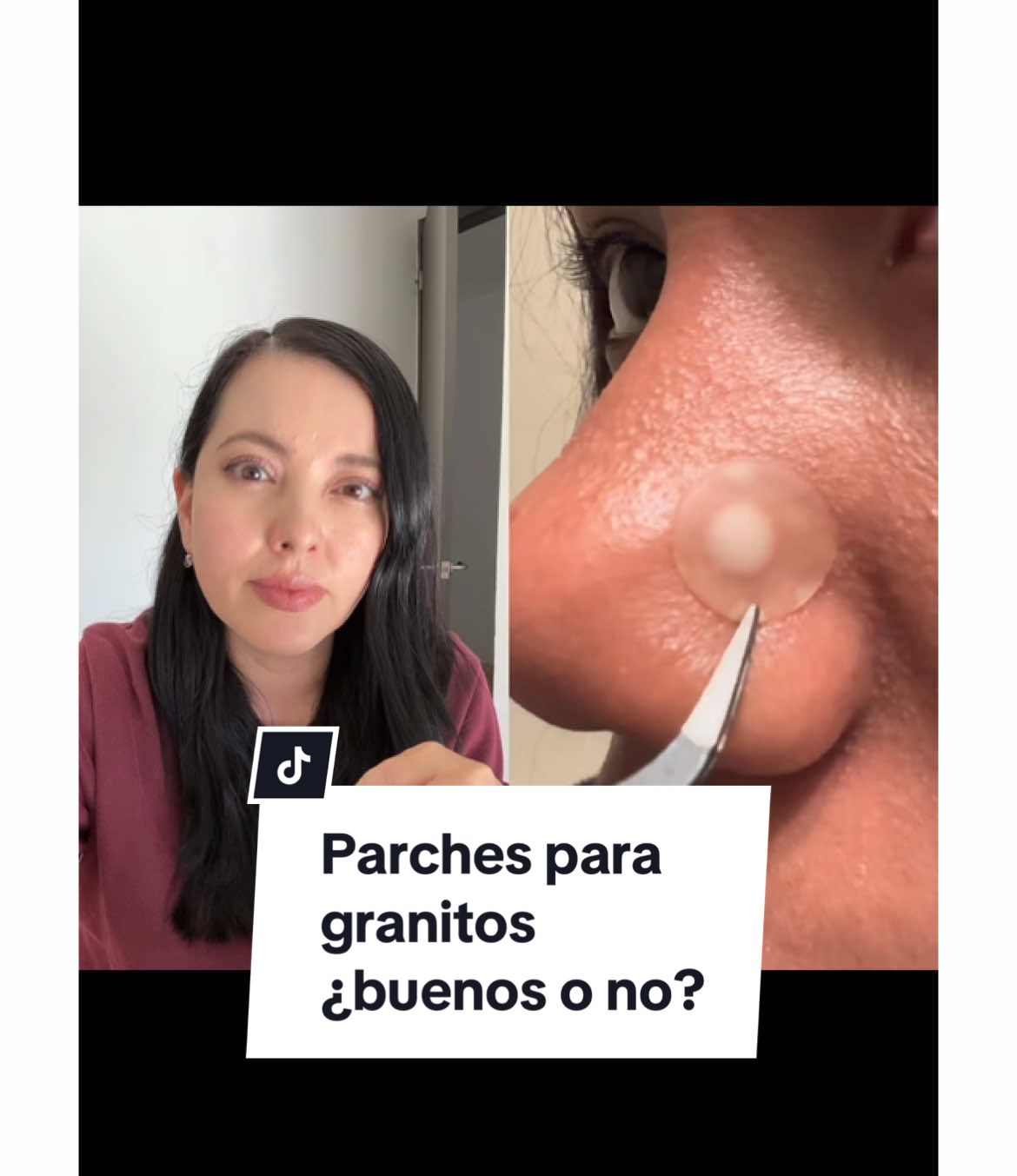 #dúo con @PeaceOutSkincare mi opinión de los parches para los granitos, no sustituyen el tratamiento, pero nos pueden ayudar a no manipular el área y evitar que nos lastimemos, son un complemento, pueden dejarme dudas o comentarios y platicamos #pimplepatch #acne #granitos #skincare #cuidadodelapiel #dermatips #skintok #parchesacne #acneparches #granitos #puntosnegros #filamentossebaceos 