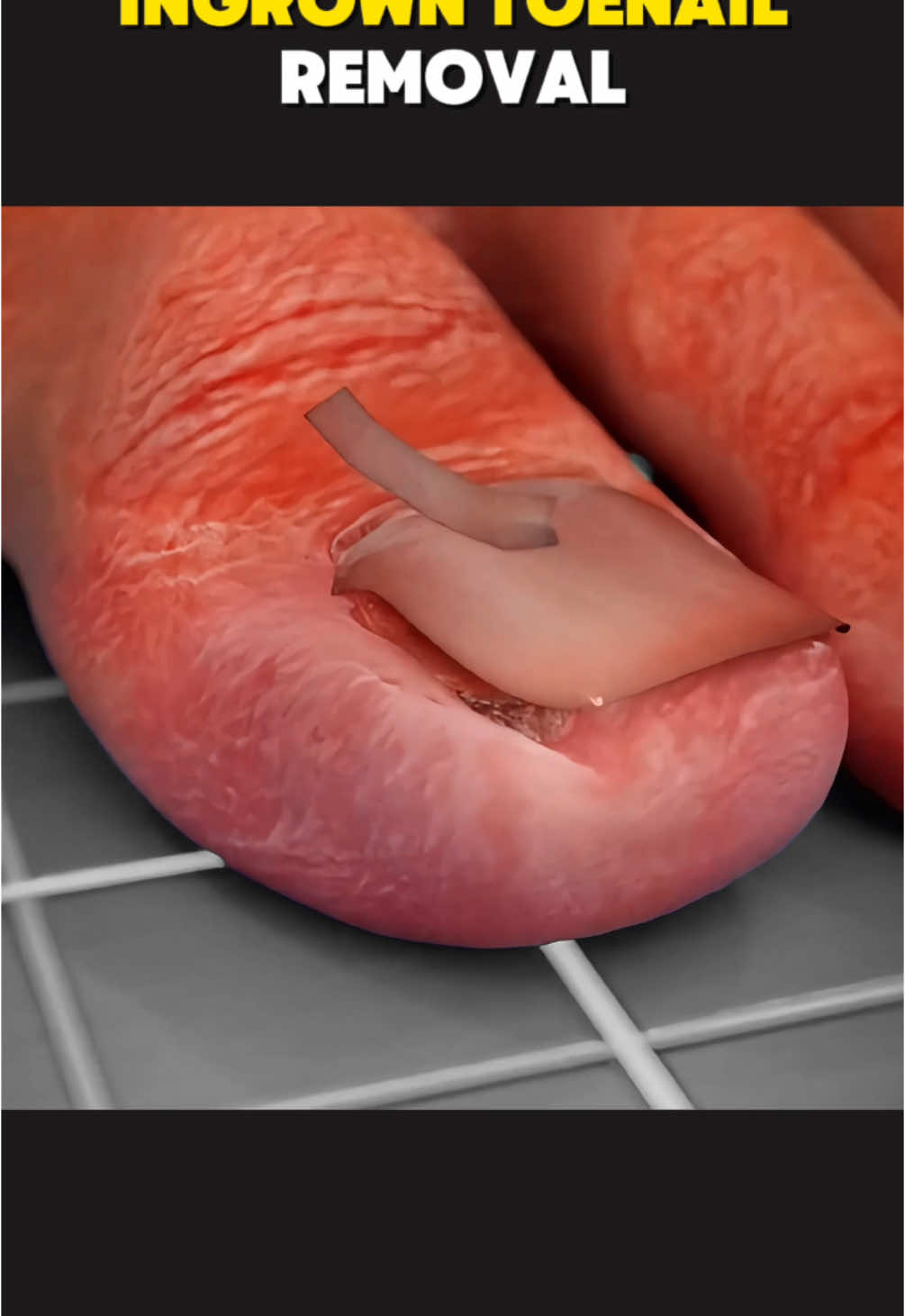 Ingrown Toenail Removal Surgery (3D Animation) #ingrowntoenail #ingrowntoenailremoval #ingrowntoenailsurgery #ingrowntoenailtreatment #ingrowntoenailremovalanimation #toenailremoval #toenailfungus #toenailsurgery #medical3danimation #3dmedicalanimation 