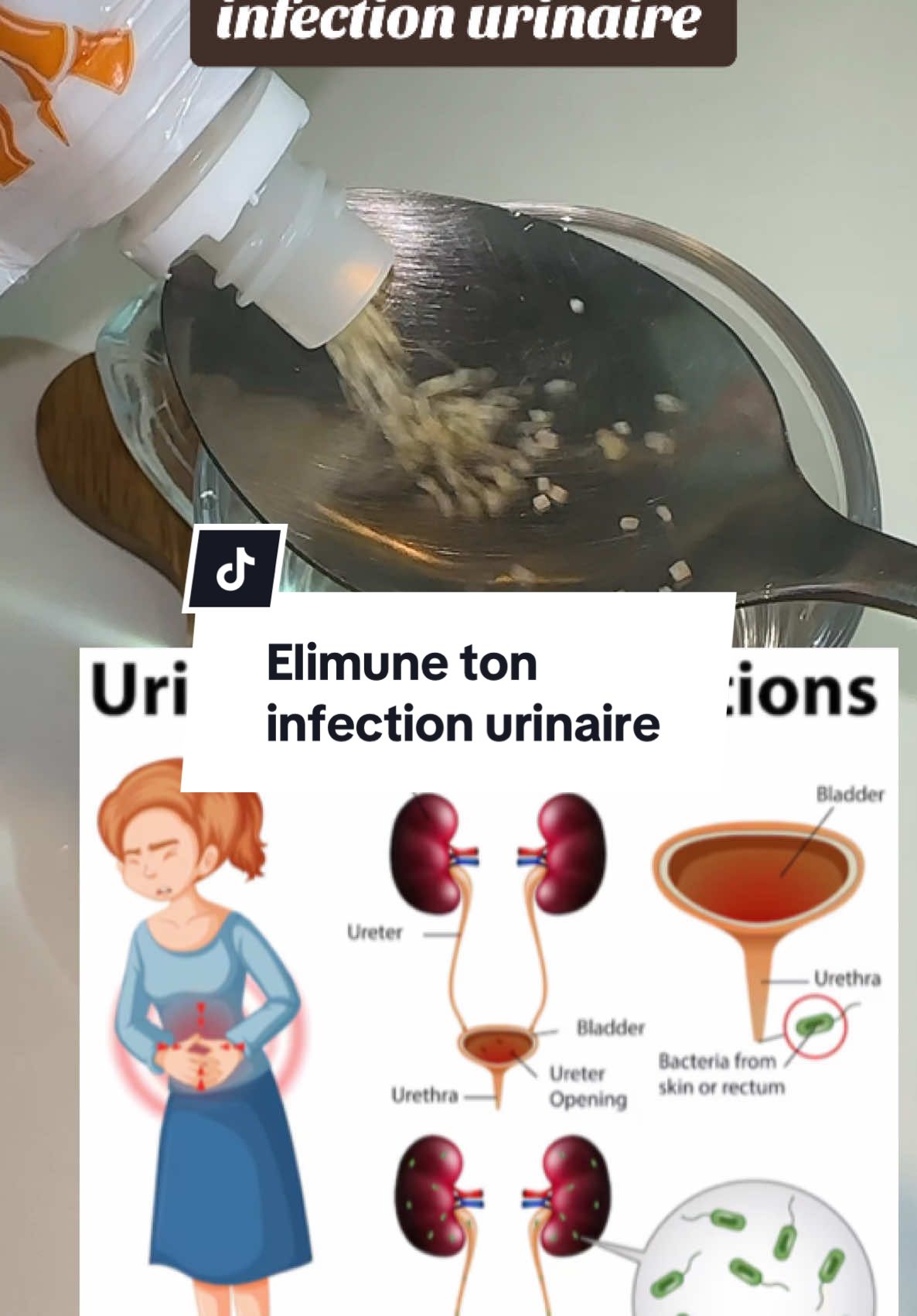 Elimune ton  infection urinaire#infection #infections #infectionurinaires #sante #remediosnaturales #santé #médecinenaturelle #astucesanté #pourtoii #fyp #explore #forupage #pourtoii #santementale  @وصفات  @وصفات  @وصفات 