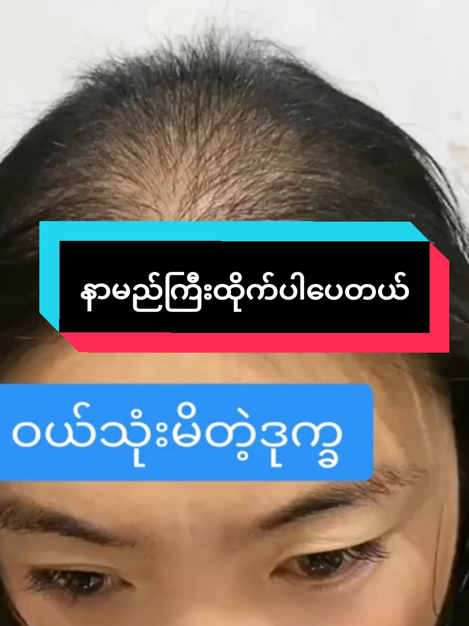 #နာမည်ကြီးထိုက်ပါပေတယ် #အကျွတ်ရပ်အုံထူအရှည်မြန်စေတဲ့အတွဲ #ဆံသားပြဿနာရှိသူများကြည့်ပေးပါ #Haircarebyklaelaet #klaelaet #foryoupage #fypage #fyp #hairstyles #hair #haircareproducts #twenty9သဘာဝထုတ်ကုန် #ရန်ကုန်လက်လီလက်ကားကိုယ်စားလှယ်ကြီး #thinkb4youdo❤️❤️ #tiktokuniverso🌍 #tiktokmyanmar🇲🇲 #ရောက်ချင်တဲ့နေရာရောက်ကွာ😍🤗🤗😅😅 