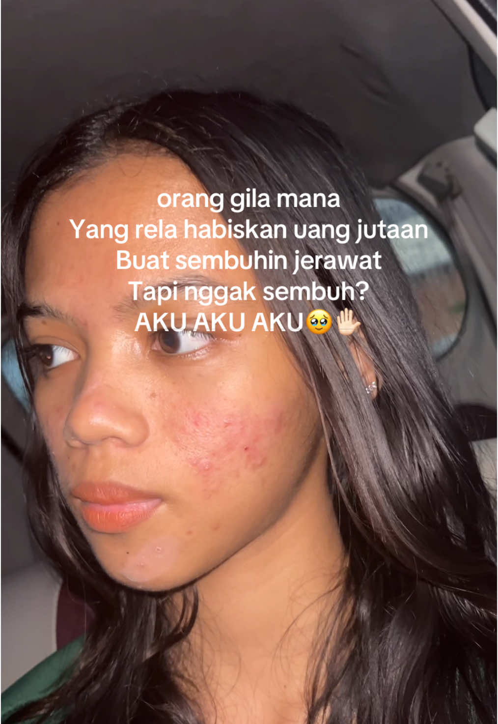 #acne #acnetreatment #acneskin #jerawat #acnejourney #pie #jerawatan #skinacne #beruntusan #jerawathormon #breakout #acnefighter #acneproneskin #bekasjerawat #kulitkering 