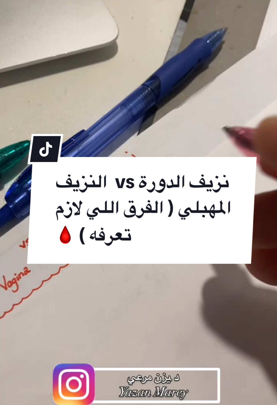 لو عندك أي أسئلة أو تجارب، شاركيها في التعليقات 💚   “في فرق كبير بين نزيف الدورة الشهرية العادي وبين أي نزيف مهبلي خارج أيامها. النزيف الشديد خلال الدورة، اللي بنسميه Menorrhagia، بيكون لو دورتك بتطول أكتر من 7 أيام أو كمية الدم بتكون أكتر من الطبيعي، يعني أكتر من 80 مل. أما أي نزيف خارج أيام الدورة، بنسميه bleeding per vagina، وده بيحتاج تقييم لأنه مش طبيعي. الفرق كمان واضح من شكل الدم: 	•	دم الدورة لونه غامق شوية وما بيتجلط (لأنه فيه مادة طبيعية تمنع التجلط). 	•	أما الدم الناتج عن نزيف مهبلي، فغالبًا بيتجلط لأنه مش مرتبط بالدورة. طيب إمتى تستشيري الطبيب؟ لو حسيتِ إن نزيفك غير طبيعي، سواء في كميته، مدته، أو توقيته. الصحة دايمًا أولوية 💚  أنا الدكتور يزن مرعي ورح كون دليلكن لطب أسهل وسلس أكثر 😉  لا تنسوا تعلموا save للفيديو ولو شايفين المحتوى مفيد انشروه عندكم بالستوري وابعتوه لرفقاتكن ولا تنسوا زكاة العلم نشره 🙏♥️  ولو بعدكن مو متابعين الصفحة تابعوها ليبقى عندكن كل جديد ♥️  #يزن_مرعي #الدكتور_يزن_مرعي #النزيف_المهبلي #نزيف_الدورة #نزيف_الدورة_الشهرية #الجراحة #طبيب_عام #طبيب_النسائية_والتوليد #طب_بشري #محتوى_طبي 