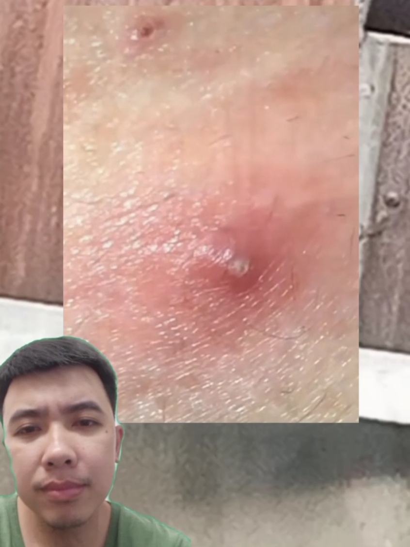 #pimple #Pimple #pimples #pimpleremover #pimplepopper2021 #pimplepopperaddict #pimplepatch #pimpleremoval #pimplepopper2022 #pimples_brufoli #satisfying #Satisfying #satisfyingvideo #satisfyingvideos #satisfyingsounds #satisfyingsound #satisfyingcleans #satisfyingasmr #satisfyingart #satisfyinglips #acne #Acne #acnetreatment #acneskin #acnefighter #acneproneskin #acnescars #acnejourney #acneskincare #acnepatch #Blackhead #blackheads #blackheadsremoval #blackheadsss #blackheadsremover #blackheadsremovalmask #blackheadsextractions #blackheadspopping #blackheadstrip #blackheadsout #blackheadsremove #foryou 