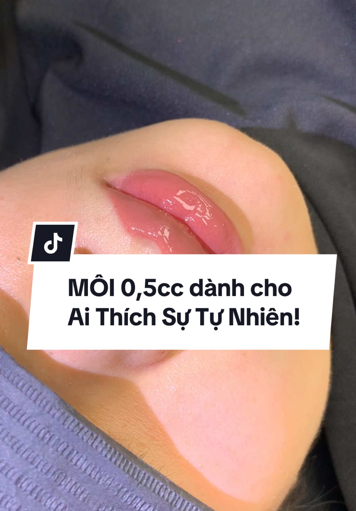 Môi 0,5cc dành cho teem thích tự nhiên #filler #lamdep #tranhueanh #thammy #xuhuong #tera 