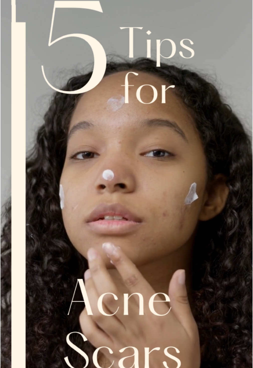 5 TIPS TO GET RID OF ACNE SCARS 🧴 Gentle exfoliation: Use chemical exfoliants like AHAs (glycolic acid) or BHAs (salicylic acid) to promote skin cell turnover. Sunscreen: Shield your scars from UV rays to prevent them from darkening—daily sunscreen is essential! Topical retinoids: Boost collagen production and improve skin texture with retinoids, but always use them under dermatological supervision. Vitamin C serums: Let vitamin C work its magic—it brightens dark spots and helps even out your skin tone. Professional treatments: For deeper scars, explore options like microneedling, chemical peels, or laser therapy, always guided by a trusted dermatologist. Want to dive deeper into these tips? Let us know in the comments! 🔎