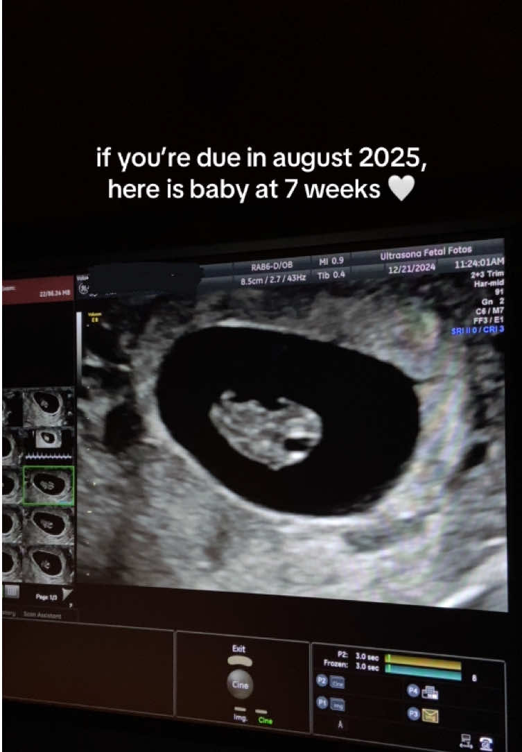 Due in August 2025 👶🏻🤍 #fyp #fyppppppppppppppppppppppp #viral #babytok #portlandultrasound #washingtonultrasound #oregonultrasound #MomsofTikTok #ultrasound #babycomingsoon #sonographer #pregnant #pregnancy #ultrasoundtech #ultrasoundstudio #firsttrimester 