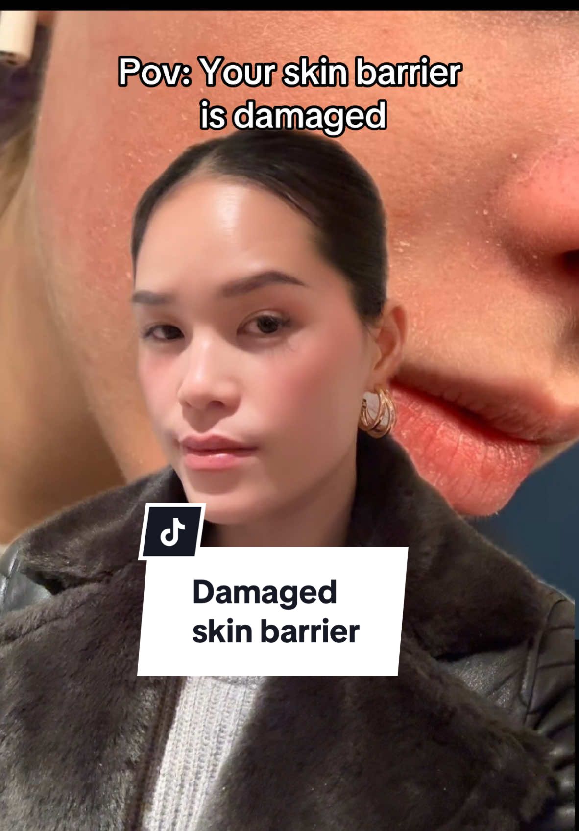 Pov: Your skin barrier is damaged  #skinbarrier #skincare #damagedskinbarrier #damagedskinbarriersigns #skinbarrierrepair #fyp #foryourepage #foryou #viralskincare #viralskincarevideos 