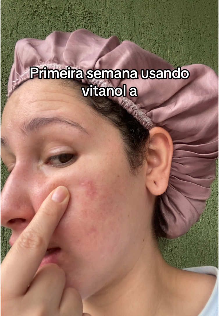 Pouco mais de uma semana usando vitanol a #peleacneica #acneskincareroutine #pelereal #acnetreatment #roacutan #tretinoina #vitanol #acneskin #cuidadoscomapele 