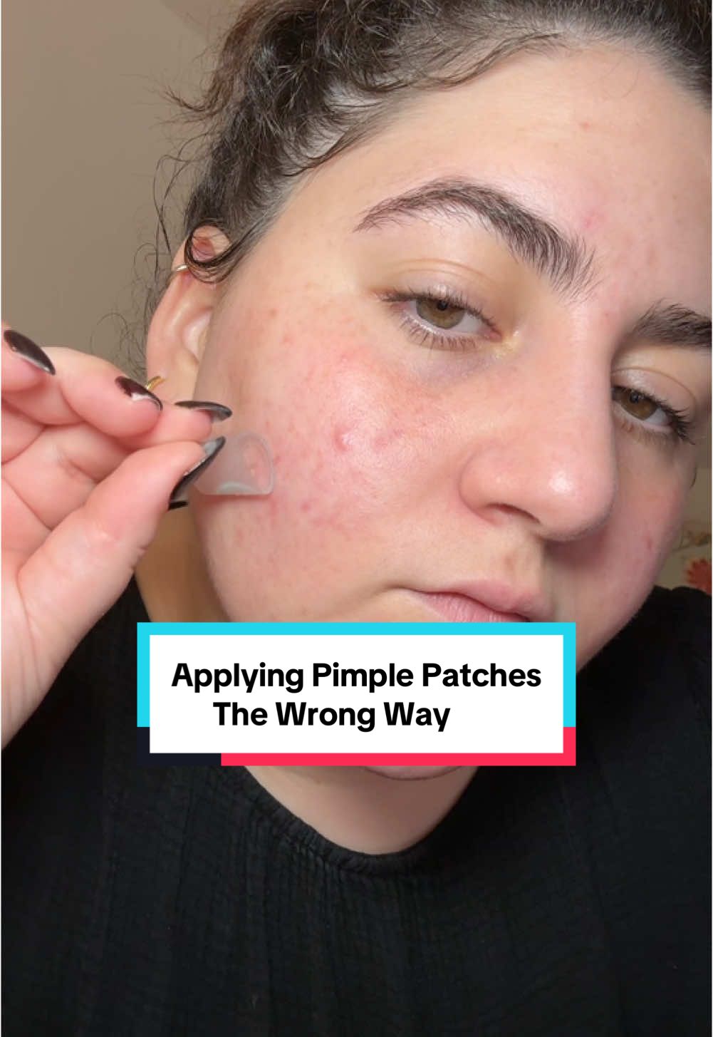 Applying pimple patches the wrong way so you don’t have to #creatorsearchinsights #pimplepatches #pimples #pimplepopper #pimplepatch #acne #acnetok 