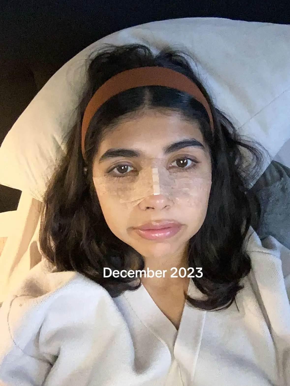 #fyp #nosejob #christmasgift #rhinoplasty #fypシ゚viral #beforeandafter 