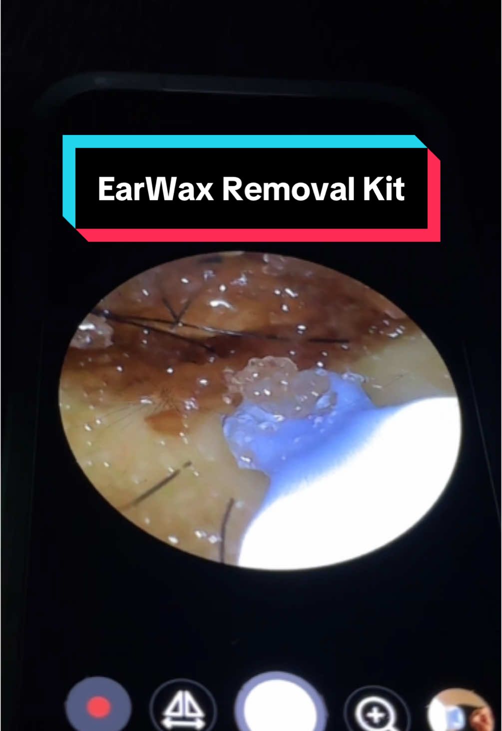 Ear Wax Removal Kit #earwax #earwaxremoval #earwaximpaction #earwaxtool #earwaxcamera #earwaxremovalkit 