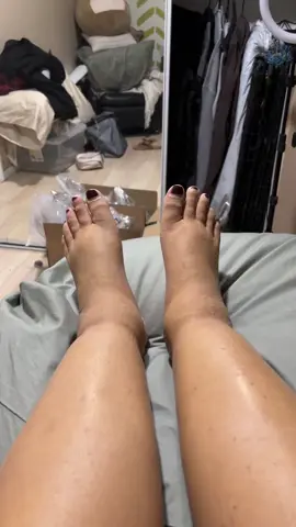 #fyp #swollenfeet #chronicillness #waterretention #fever #nausea #jaundice 