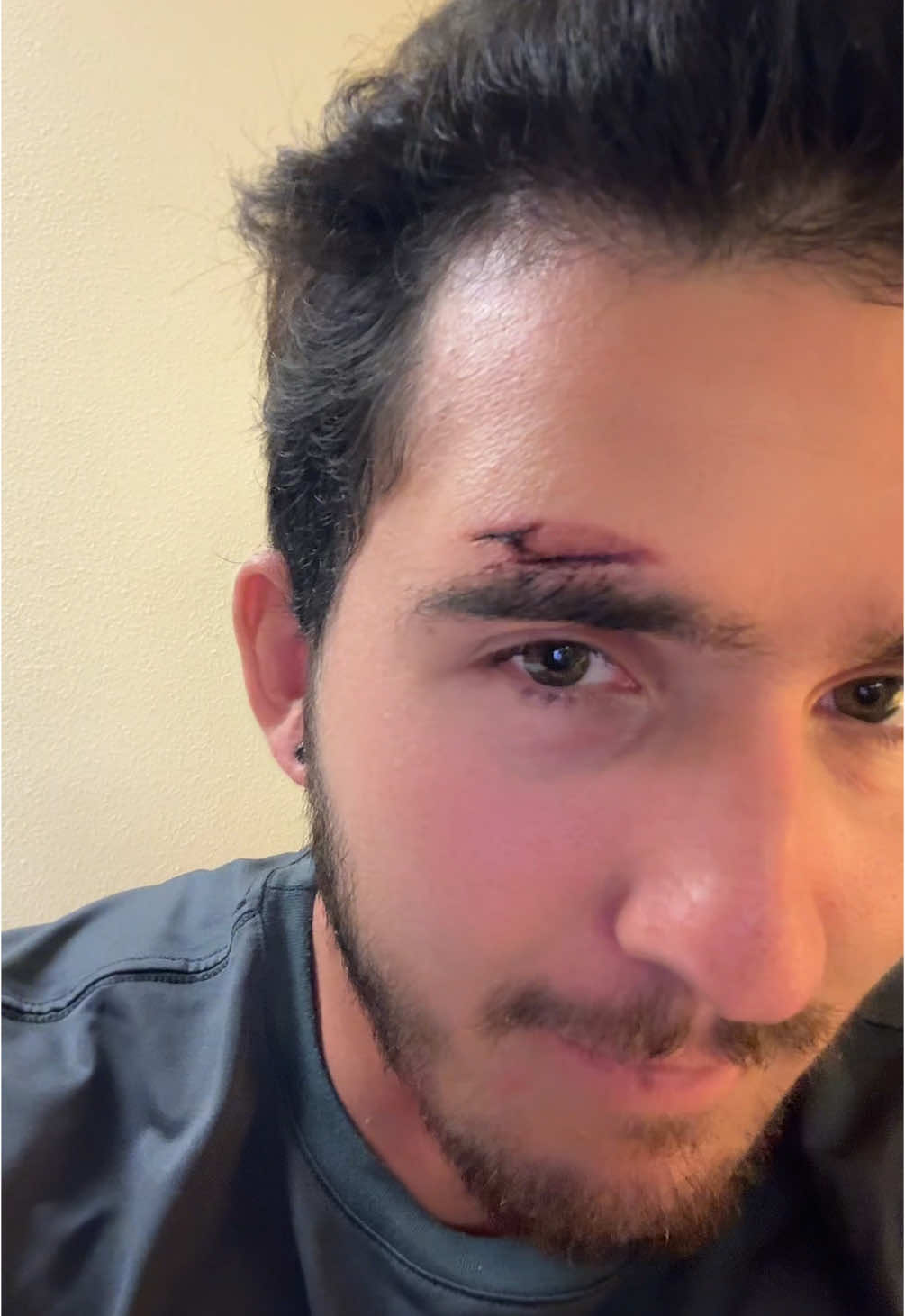 Replying to @Archluvslax The end result after a board to the head #surfing #surfaccident #concused #laceration #waikiki #oahu #hawaii #ocean #fyp 