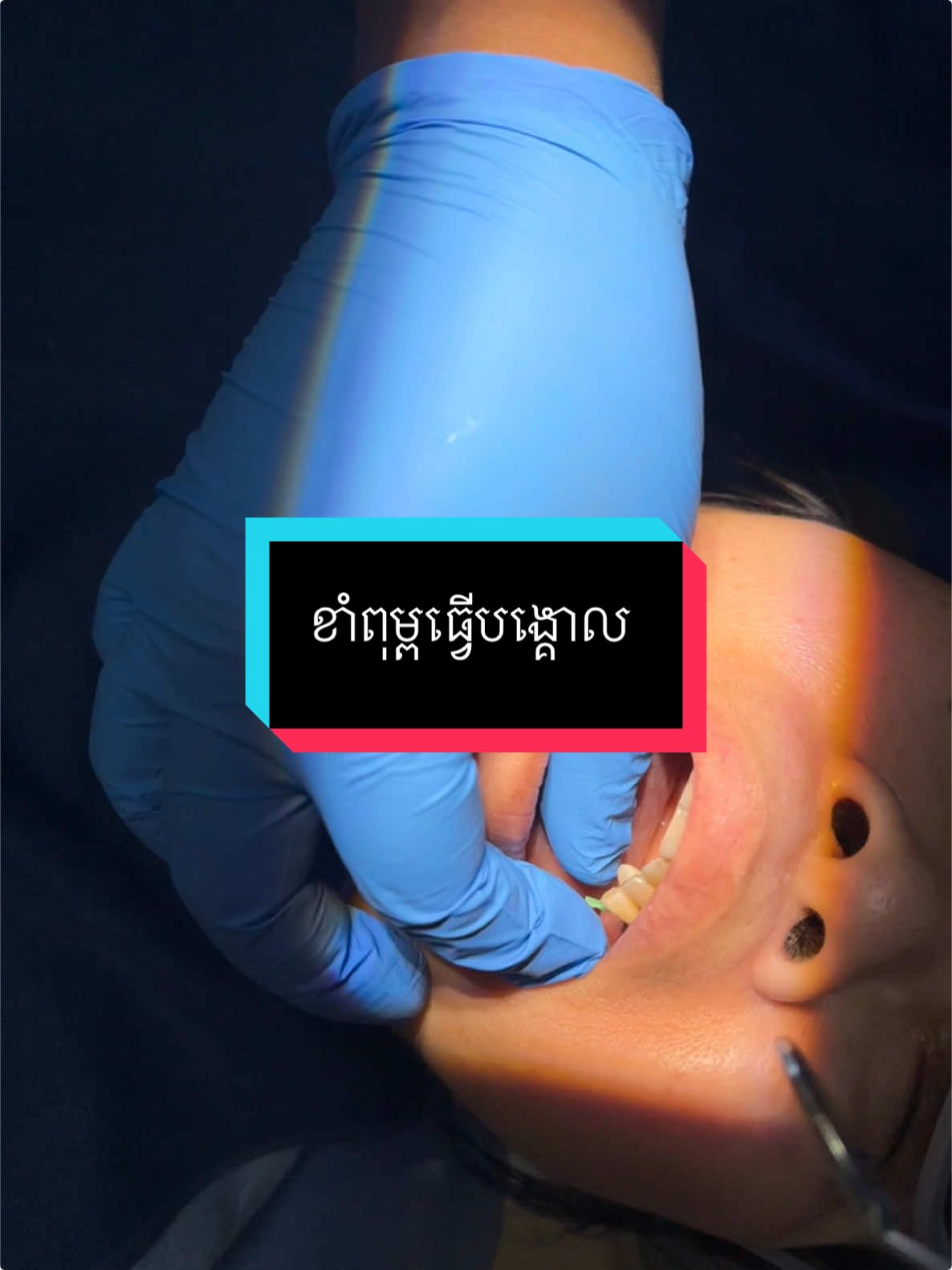 ខាំពុម្ពធ្វើបង្គោល #greatsmiledentalclinic #គ្លីនិកធ្មេញគ្រេតស្មាល #braces #teamធ្មេញដែក #ព្យាបាលធ្មេញ #ធ្មេញដែក 