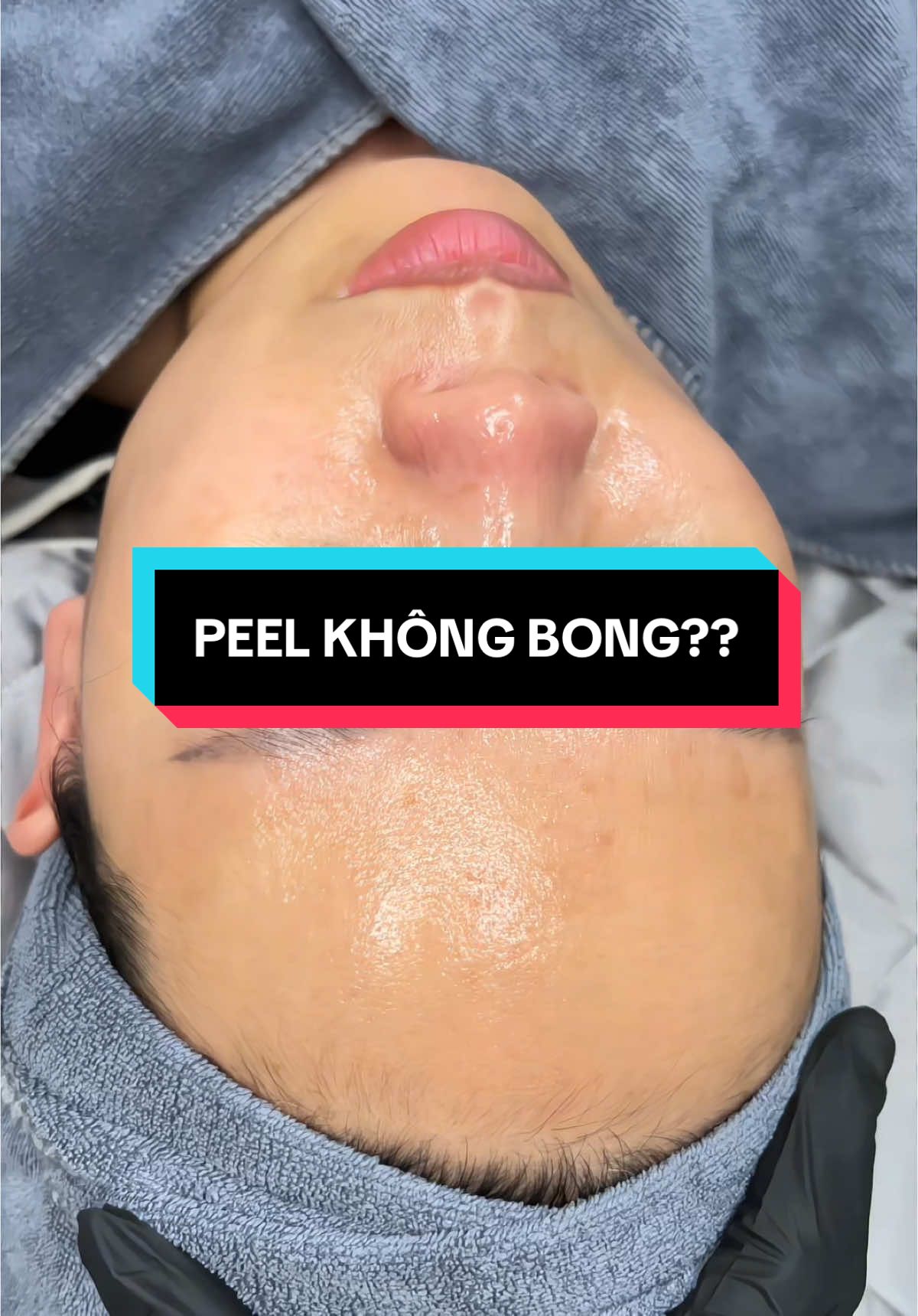 PEEL CĂNG BÓNG KHÔNG BONG  Liệu trình bóng thật no ảo  Phương pháp dành cho ce nào sợ bong tróc mà vẫn muốn có làn da đẹp căng bóng🙆‍♀️ 📍 𝐏𝐄𝐄𝐋 𝐌𝐀𝐍𝐃𝐄𝐋𝐈𝐂 • Kháng khuẩn ngừa mụn,  • Kéo nước bổ sung ẩm bề mặt cho da,  • Loại bỏ sừng, bít tắc & mụn ẩn,  • Kích thích tái tạo tế bào giúp trẻ hóa da, giảm thâm, căng bóng trắng hồng  • Giàu chất chống oxy hóa giúp đem lại hiệu quả cả với làn da lão hóa. Nếu các chị em muốn tái sinh làn da, thay da trẻ hóa mà không gây bong tróc, phù hợp với làn da nhạy cảm thì  𝐏𝐄𝐄𝐋 𝐌𝐀𝐍𝐃𝐄𝐋𝐈𝐂  là 1 sự lựa chọn không thể hoàn hảo hơn ạ😗😗 #HACIBEAUTY #peelkhongbong #Mesotherapy #peelcangbong#peeelmandelic #peelda  #dieutridakhoahoc #xuhuong #fyp 