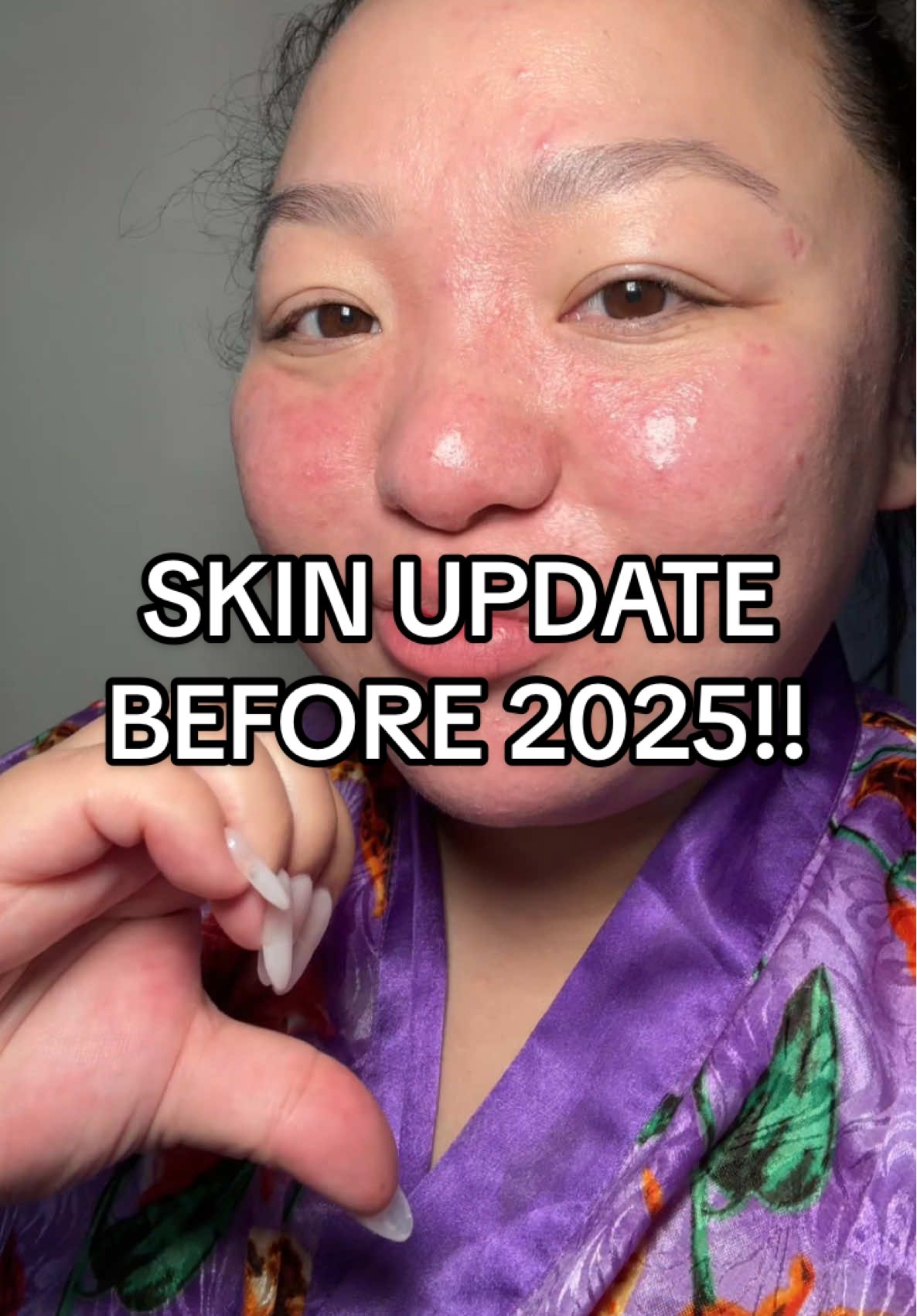 #stitch with @sultanaxiong it’s almost going to be a year since I have started my skin healing journey. I can’t believe how far I have come. ##skincareroutine##skinupdate##HealingJourney##rosacea##acne##accutane##ivermectin##skintok##skinfluencer##tiktokpartner##acneskin