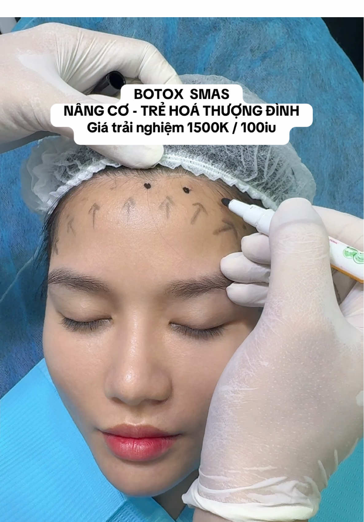 Kéo căng da phần trán cau mày và đuôi mắt #phongkhamdalieuqclinic #pkckdalieuqclinic #botox #nângcotrẻhoáda 