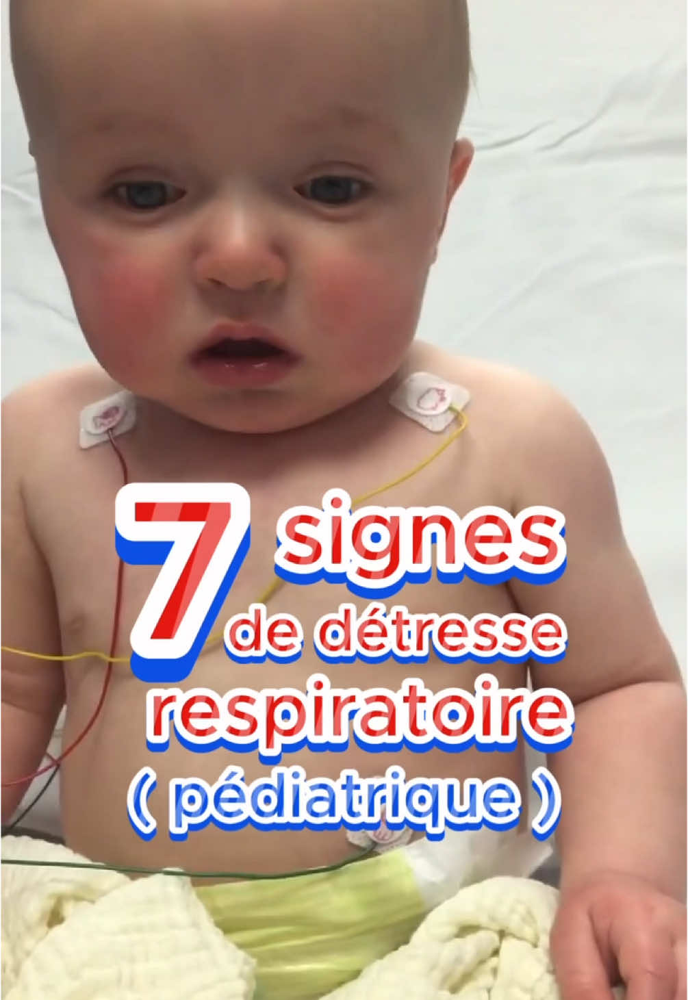 ⬇️ L’essentiel à savoir sur les signes de détresse respiratoire chez l’enfant. 🎯 Pourquoi c’est important ? La détresse respiratoire chez les enfants peut évoluer rapidement. Reconnaître les signes cliniques est vital pour une prise en charge immédiate.  🔍 Signes de lutte, qui témoignent de l’effort intense des muscles respiratoires accessoires : - Battement des ailes du nez : Dilatation des narines à chaque inspiration. - Tirage : Dépression visible des parties molles (intercostal, sus-claviculaire, sous-sternal). - Balancement thoraco-abdominal : Mouvement paradoxal où l’abdomen et la cage thoracique se déplacent en sens opposés. - Bobbing : Mouvement saccadé de la tête, lié à l’utilisation des muscles du cou comme muscles respiratoires accessoires. ⚠️ Signes de gravité - Altération de la conscience : agitation, somnolence, confusion. - Cyanose (lèvres, extrémités) : témoigne d’une oxygénation insuffisante. - Fréquence respiratoire modifiée : polypnée (compensation) ou bradypnée (épuisement). 🔈 Bruits respiratoires : - Stridor : Bruit inspiratoire aigu en cas d’obstruction des voies aériennes supérieures. - Wheezing : Bruit expiratoire, souvent signe d’une obstruction bronchique. - Grunting : Gémissement causé par une glotte partiellement fermée, fréquent chez les nouveau-nés. 👉 Enregistre cette vidéo pour y revenir plus tard et partage-la avec un.e ami.e ! 🙌 👨🏻‍🏫 Source Dyspnées chez l’enfant, A. LAMPASONA (2013), @sfmu.jeunes  #objectiftousformes #infirmier #infirmiere #pédiatrie #enfant #nourrisson #secourisme #urgence #aasc #bspp #sapeurspompiers #pompiersdeparis #samu #smur #médecine #esi #ifsi #ide #soignante #aidesoignant #ambulancier #santé #réanimation #arretcardiaque #premierssecours