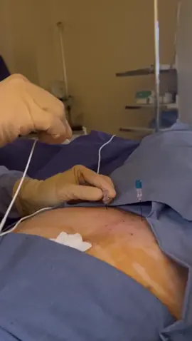 Centro de Dolor Crónico Benigno y Maligno de Neurocenter10. Mostramos video sobre el tratamiento de síndromes dolorosos míofasciales más frecuentes de pelvis  posterior. #fyp #cerebral #tecnología #neurocirujano #neurocirugia #gdl 