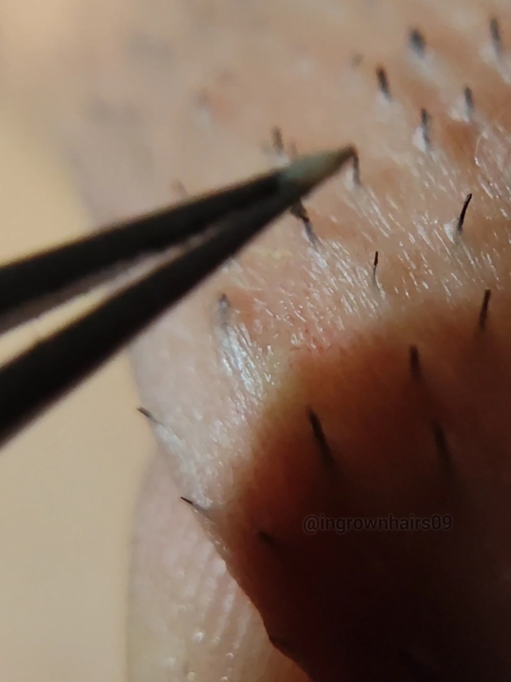 satisfying ingrown hair extractions!🫶🏼 #relax #asmr #tweezers #ingrownhairremoval #satisfyingvideo #hairpulling #plucking #ingrownhair #extractions 