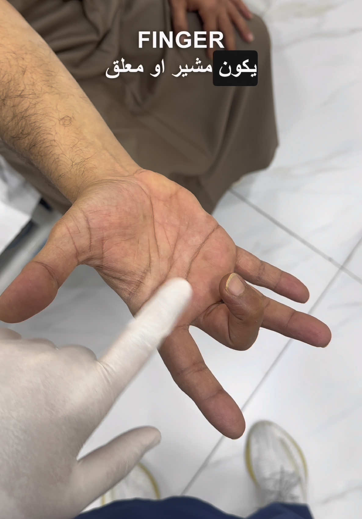 Trigger finger #qatar🇶🇦 #physiotherapy #اكسبلور #foryou #fybシ 